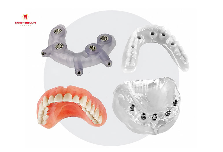All On 4 Implants With Surgical Guide full-arch all on 4 implant surgical guide