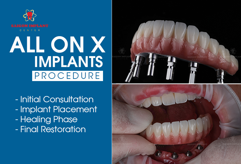All On X Dental Implants Procedure all on x dental implants
