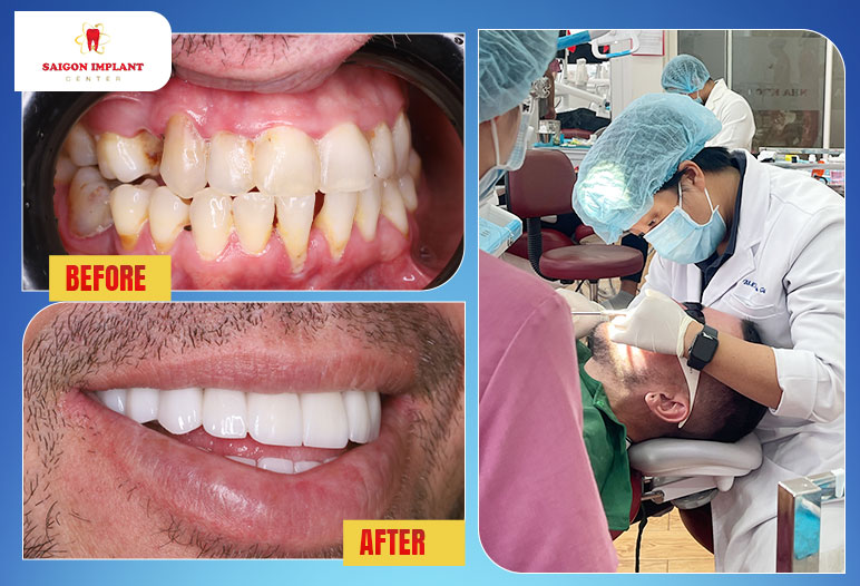getting dental crowns in vietnam