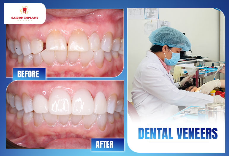 Smile design with dental crowns