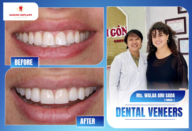 getting dental veneers in vietnam