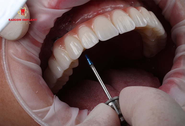 Full Set Of Teeth full set of teeth