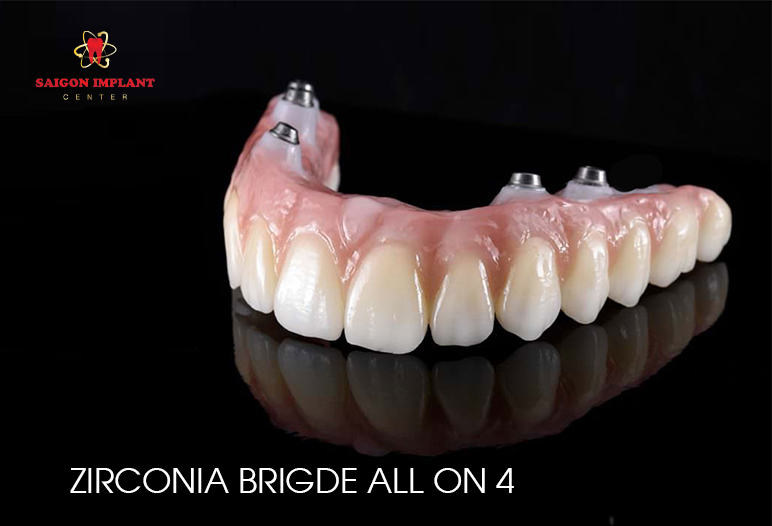 Zirconia Bridge All On 4 1 zirconia bridge all on 4