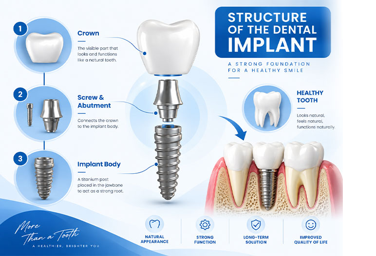 Dental Implants Structure dental implant structure