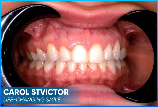 Carol Stvictor's case after procedure