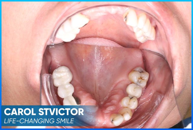 Carol Stvictor's case before procedure