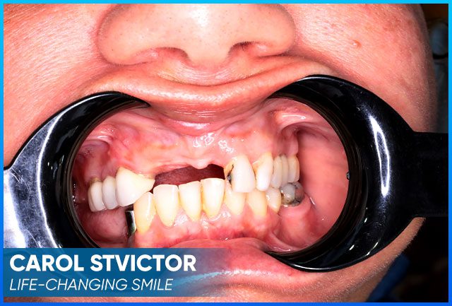 Carol Stvictor’s case before procedure