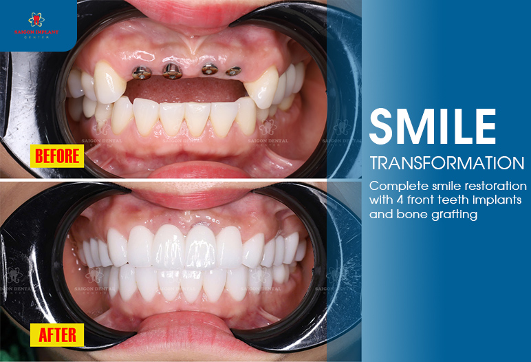 dental implant and bone graft