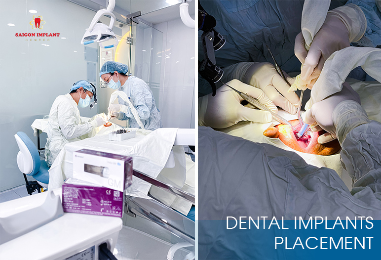 The best dental implant in Saigpn