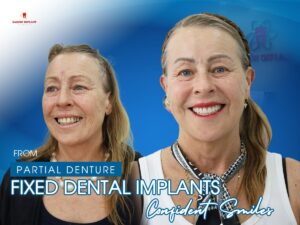 all on 4 dental implant