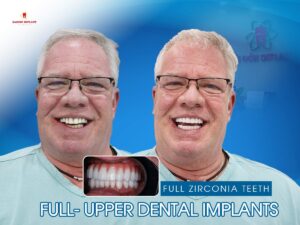 full upper dental implant vietnam