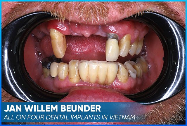 Jan Willem Beunder's case before