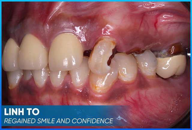 Mrs. Linh To's case before procedure