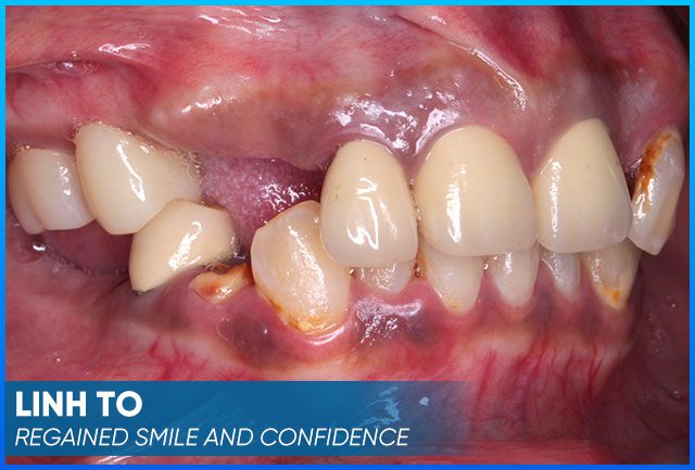 Mrs. Linh To's case before procedure