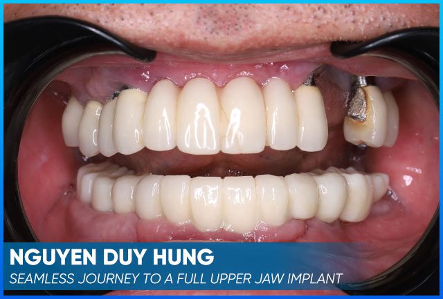 Nguyen Duy Hung's case before procedure