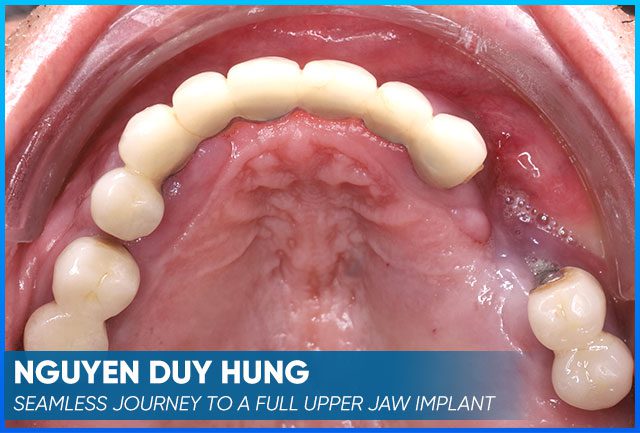 Nguyen Duy Hung's case before procedure