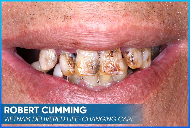 Robert Cumming's picture before the dental implants procedure