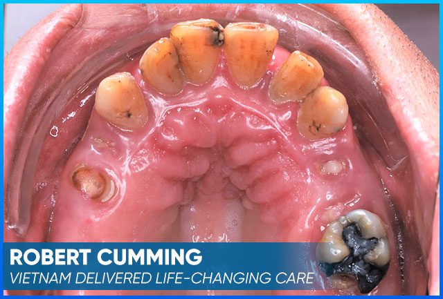 Robert Cumming's picture before the dental implants procedure