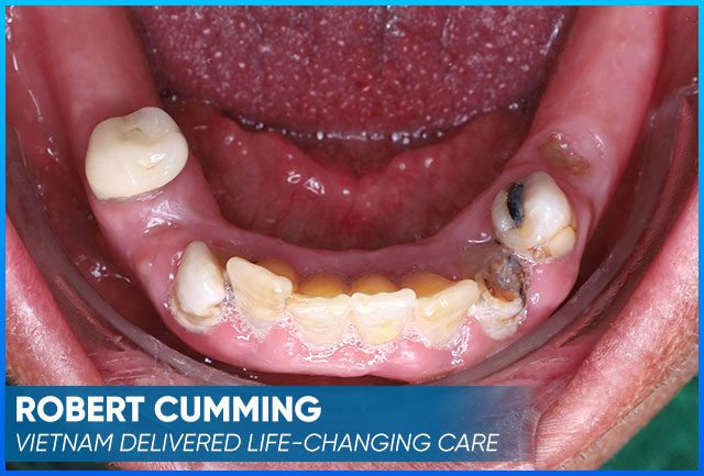 Robert Cumming's picture before the dental implants procedure