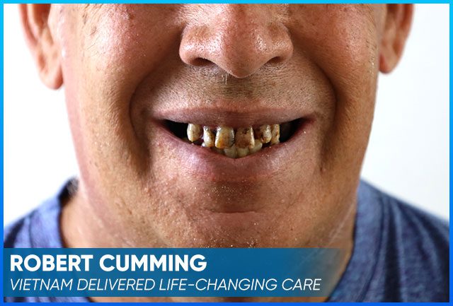 Robert Cumming's picture before the dental implants procedure