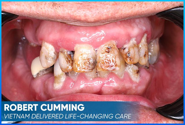 Robert Cumming's picture before the dental implants procedure