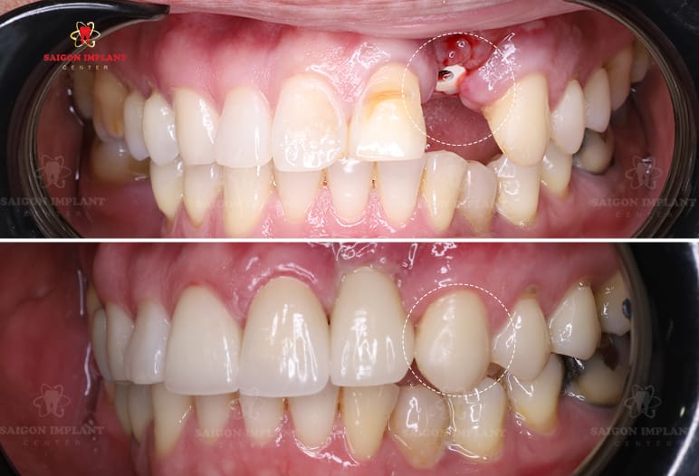 Single implant before after