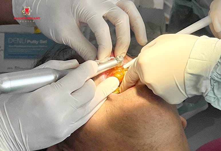 digital surgical guide implant