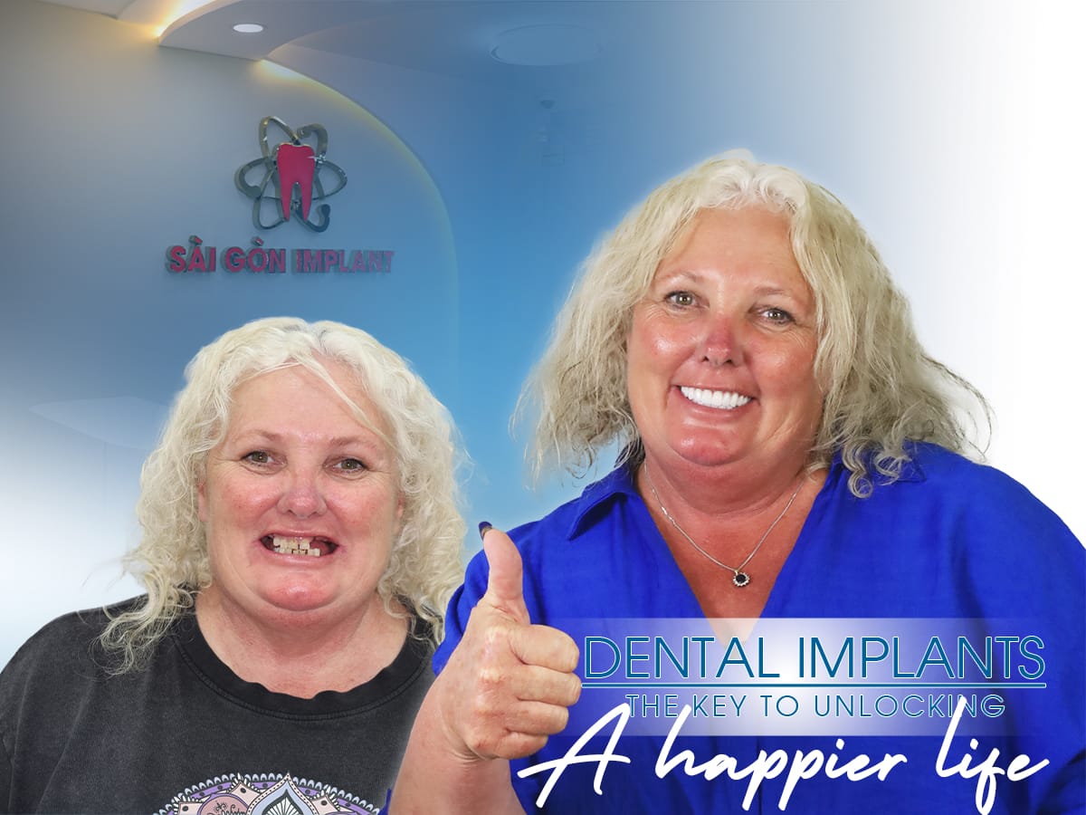 all on 4 implant before after Best all on dental implant in Vietnam