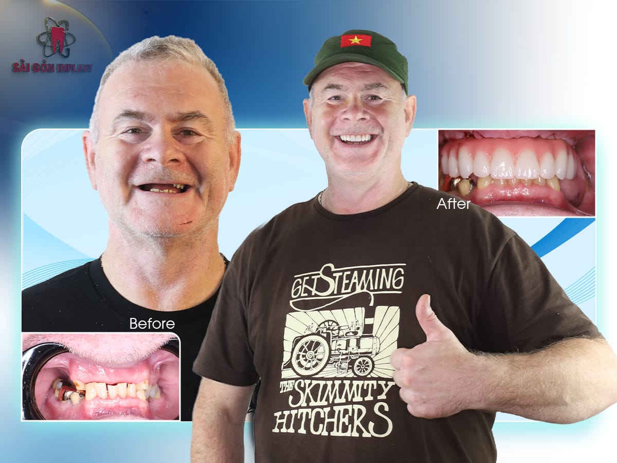full arch dental implant full arch dental implant