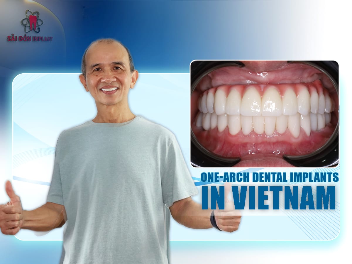 one arch dental implant vietnam One arch dental implant district 1 saigon