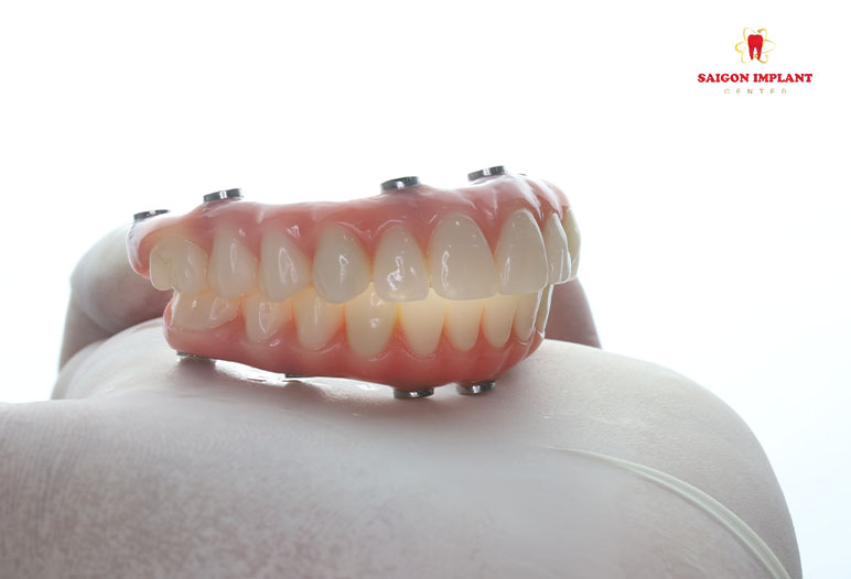 dental implant teeth