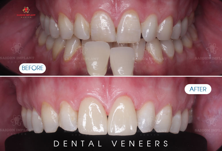 dental veneer before after