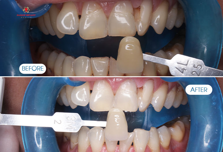 teeth whitening district 1 ho chi minh city