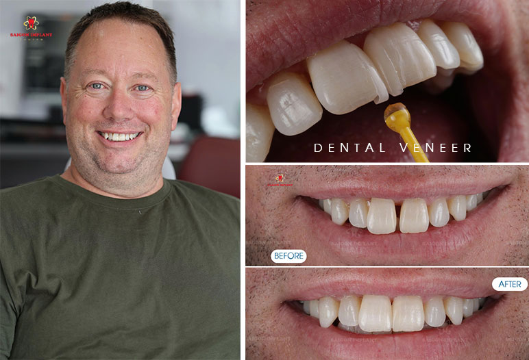 dental veneer before after