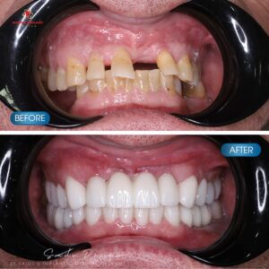 dental implant in vietnam