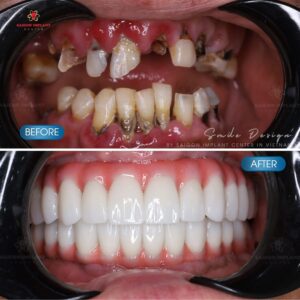 whole mouth dental implant in vietnam