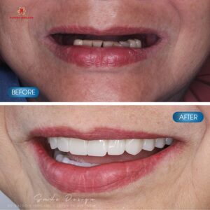 full-mouth dental implants