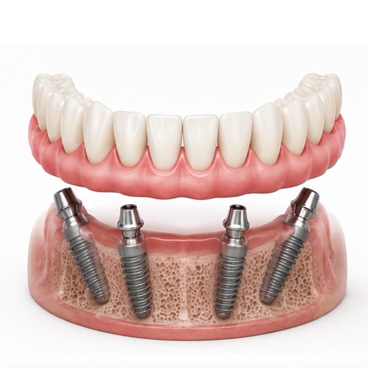 all on 4 full arch dental implant