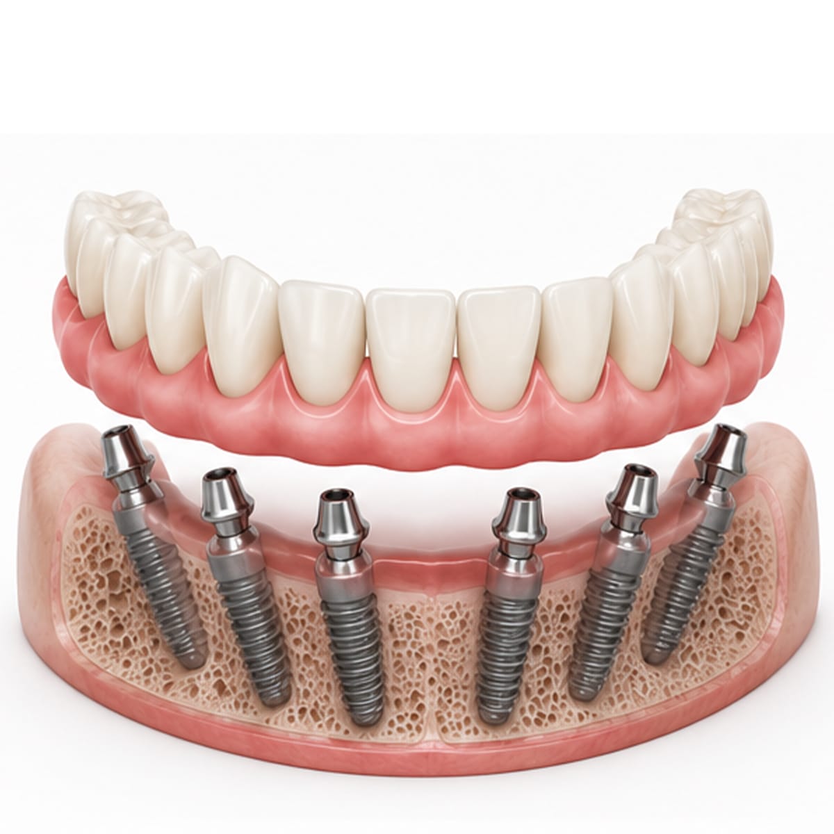 all on 6 full arch dental implant