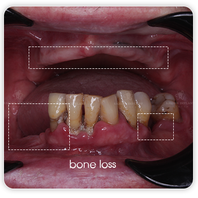 bone loss