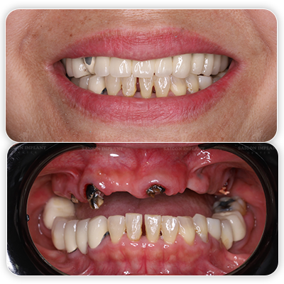 dental bridge fail