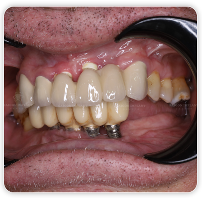failed implant