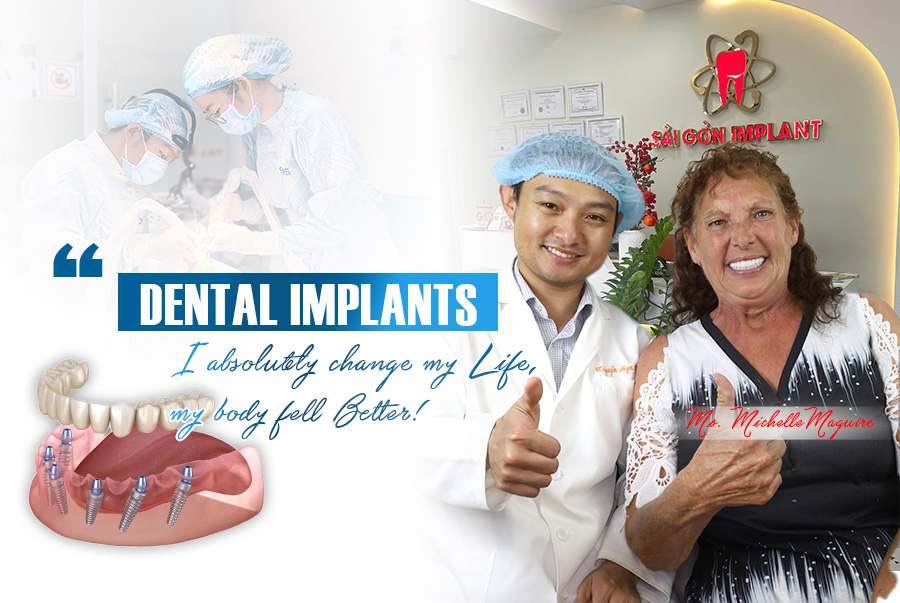 full-arch all on 6 dental implants