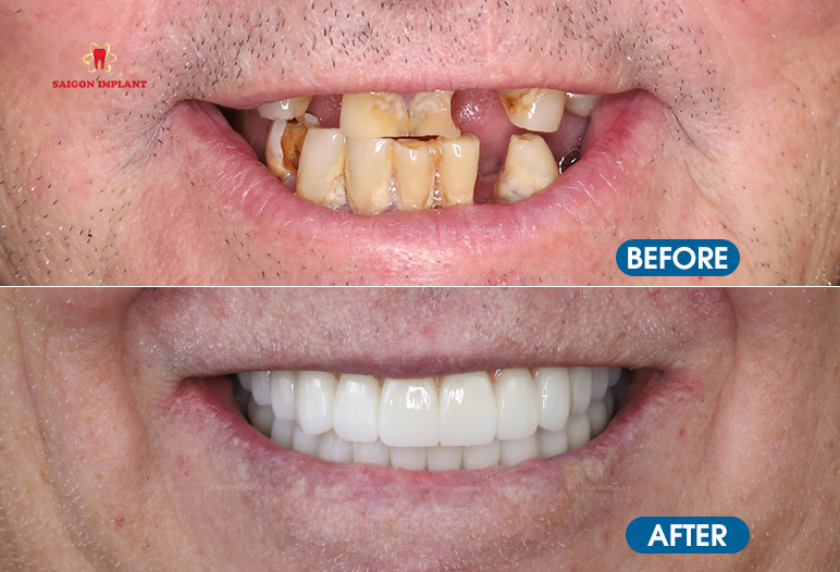 Full Mouth Denntal Implants are dental implant worth it
