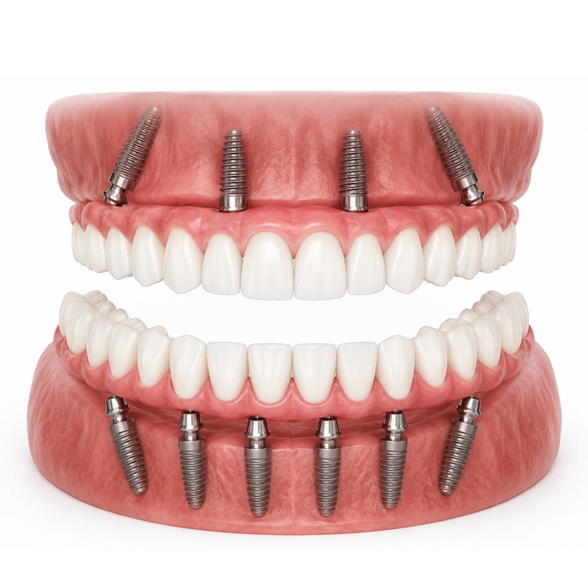 full mouth dental implant