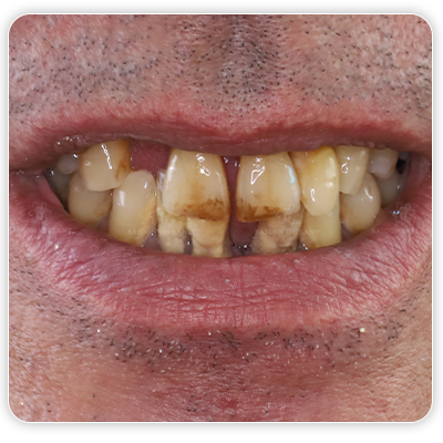 gum disease