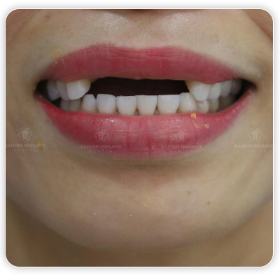 missing front teeth