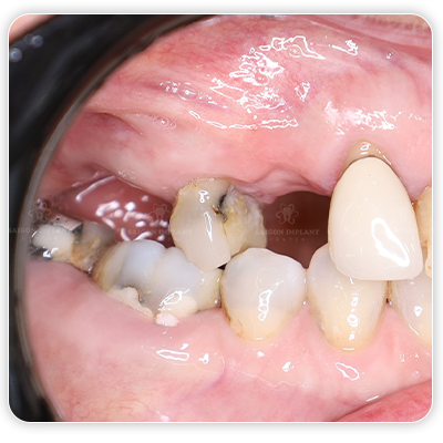 missing molar
