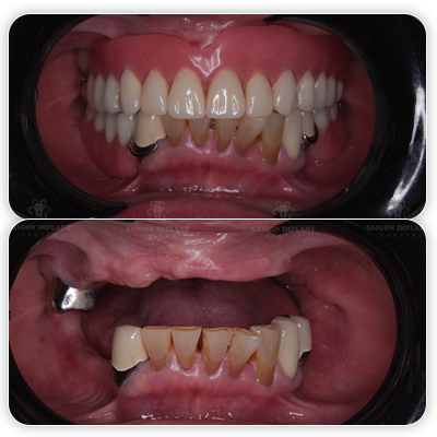 removal denture