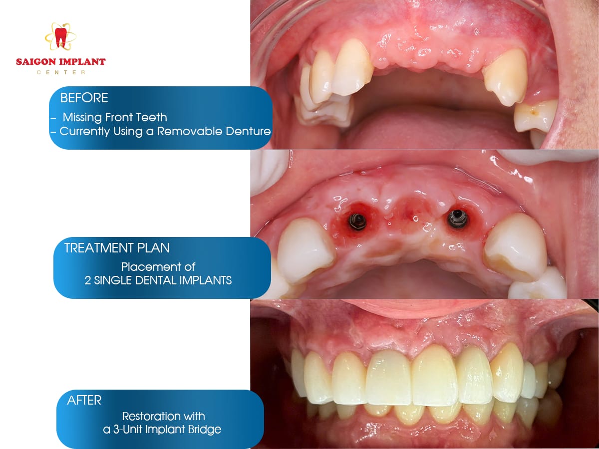 screwless front tooth implant before after